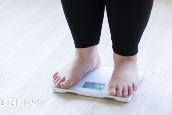 Some children at obesity clinics have BMI of 50